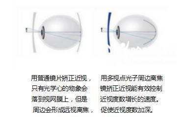 孩子眼睛度數持續加深？光學鏡片選擇與科學防控是關鍵